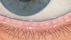 Efron osztályozási skála - Blepharitis - a szemhéjszél gyulladása - súlyosság 0