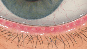 Efron osztályozási skála - Blepharitis - a szemhéjszél gyulladása - súlyosság 1