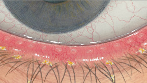 Efron osztályozási skála - Blepharitis - a szemhéjszél gyulladása - súlyosság 2