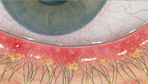 Efron osztályozási skála - Blepharitis - a szemhéjszél gyulladása - súlyosság 3