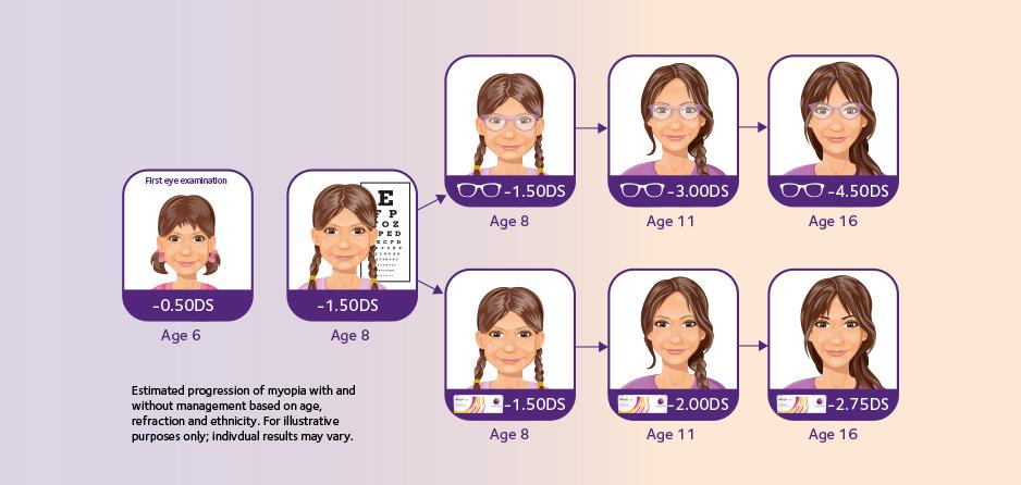 Introduce treatment at an early stage with MiSight 1 day Introduce treatment at an early stage with MiSight 1 day